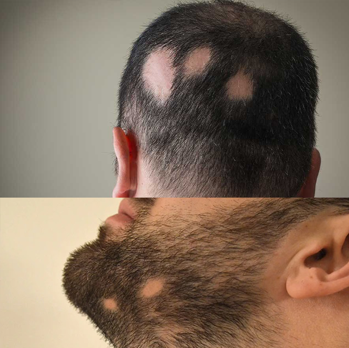 Alopecia