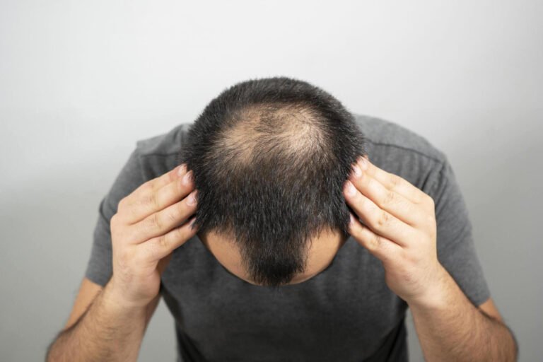 Hair loss treatment